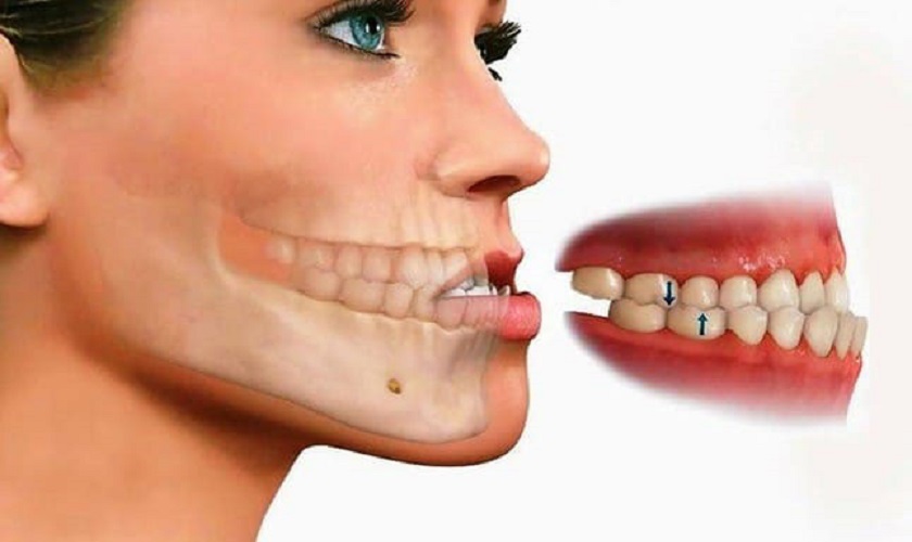 Sẽ móm là gì? Nguyên nhân, dấu hiệu và cách khắc phục hiệu quả 2 Sẽ móm là gì?