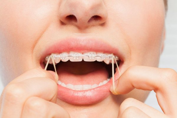 Chun Niềng Răng Là Gì? Công Dụng, Phân Loại Và Những Lưu Ý Khi Sử Dụng 2 Chun niềng răng là gì?