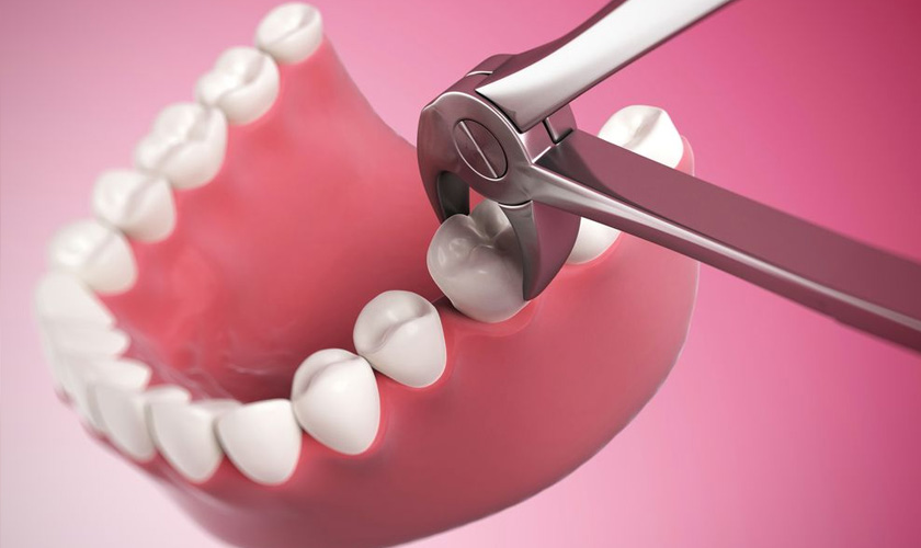 Con người có bao nhiêu răng? 4 điều thú vị về số lượng và chức năng răng người 4 Răng cấm có nhổ được không?