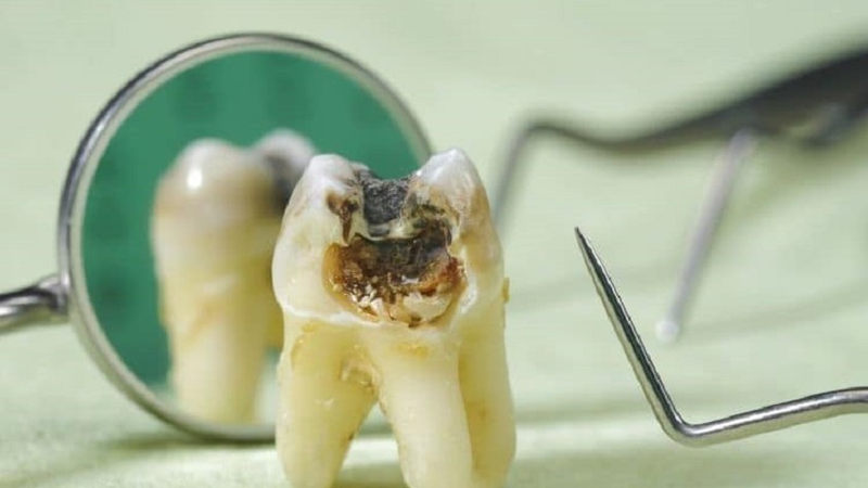 Răng cấm có nhổ được không? Vì sao họ lại cần phải nhổ răng cấm? 4 nho rang cam co nguy hiem khong 1 96723685b8