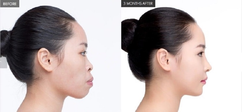 Có nên niềng răng không? Những lợi ích và điều cần cân nhắc trước khi quyết định 3 nieng rang co lam thay doi khuon mat 2
