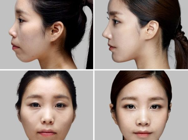 Niềng răng có làm thay đổi khuôn mặt không? Giải đáp từ góc nhìn chuyên gia 2 Niềng răng có làm thay đổi khuôn mặt không? Niềng răng có làm thay đổi khuôn mặt không?