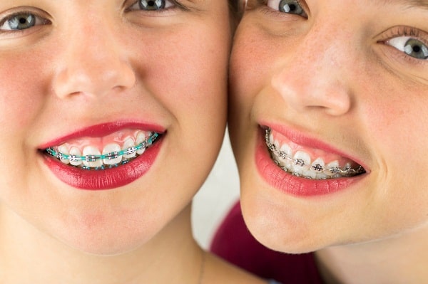 Đánh lún răng bằng dây cung: Kỹ thuật chỉnh nha giúp hạ thấp răng đúng vị trí 4 nieng rang ho loi 3 1