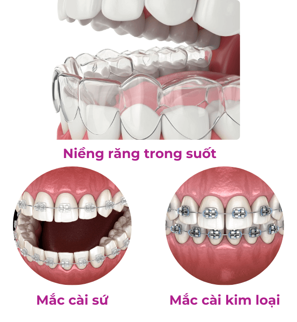 Cung răng là gì? Vai trò, cấu trúc và những vấn đề thường gặp 4 cung răng