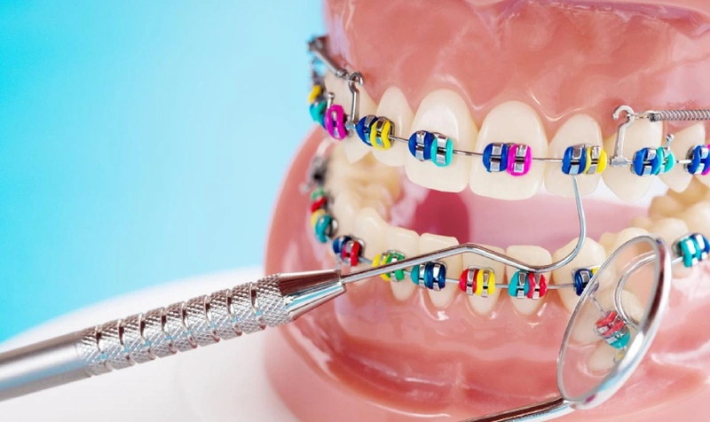 Niềng răng giúp cải thiện thẩm mỹ nụ cười và gương mặt