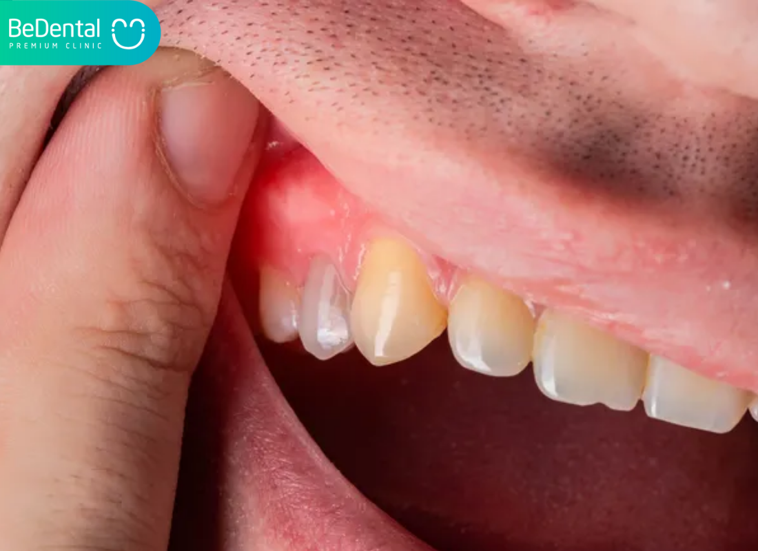 Nổi cục cứng ở lợi
