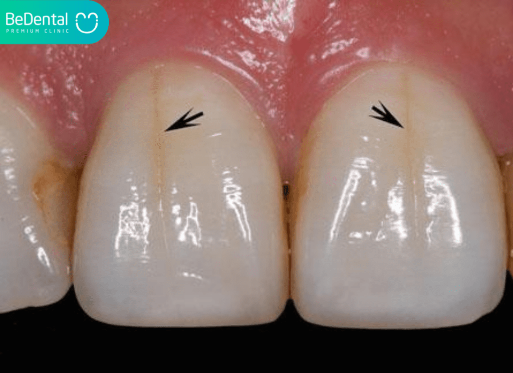 Nứt Răng Cửa: Nguyên Nhân Răng Bị Vỡ, Tác Hại Và Giải Pháp Khắc Phục 3 nut rang cua 2