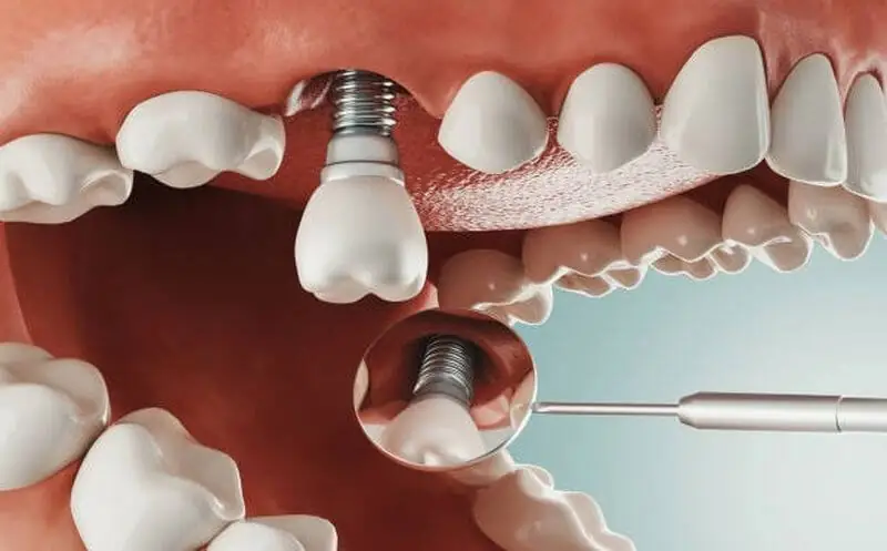 Trồng răng Implant giá rẻ. Trồng răng Implant giá rẻ. Trồng răng Implant giá rẻ
