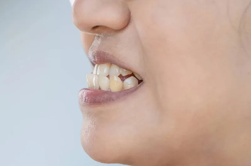 Sẽ móm là gì? Nguyên nhân, dấu hiệu và cách khắc phục hiệu quả 9 rang mom.jpg