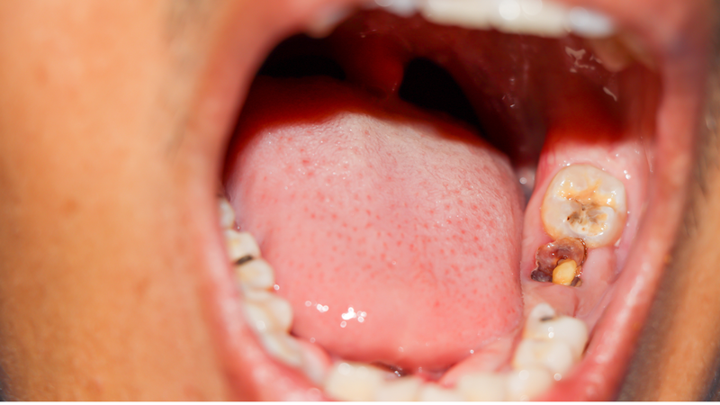 Hậu quả của răng hàm bị vỡ