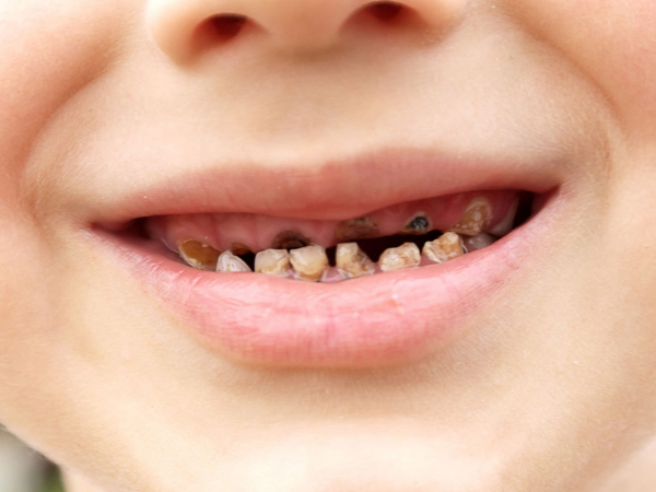Bắt sâu răng qua mắt: Công nghệ chẩn đoán sớm bằng hình ảnh có khả thi không? 4 Bắt sâu răng qua mắt. Bắt sâu răng qua mắt.Bắt sâu răng qua mắt. Bắt sâu răng qua mắt