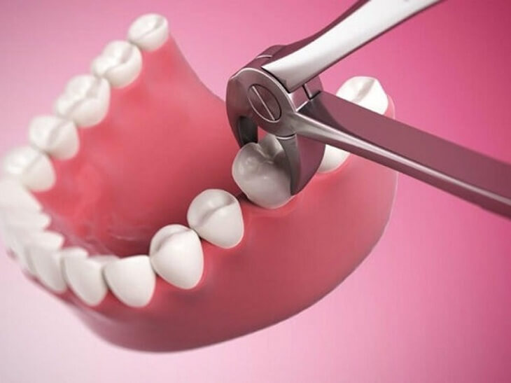 Răng số 5: Vai trò quan trọng và những điều bạn cần biết 2 Răng số 5. Răng số 5. Răng số 5. Răng số 5