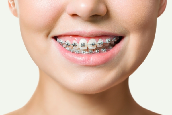 Có nên niềng răng không? Những lợi ích và điều cần cân nhắc trước khi quyết định 4 Những điều cần biết trước khi niềng răng