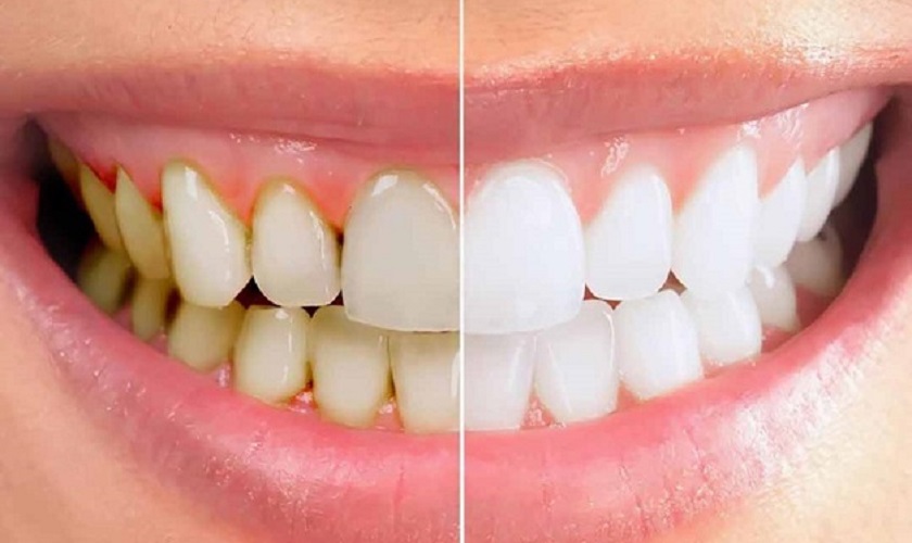 Máy lấy cao răng tại nhà: Có nên sử dụng không? Ưu – nhược điểm và 5 điều cần lưu ý 4 tac hai cua viec lay cao rang