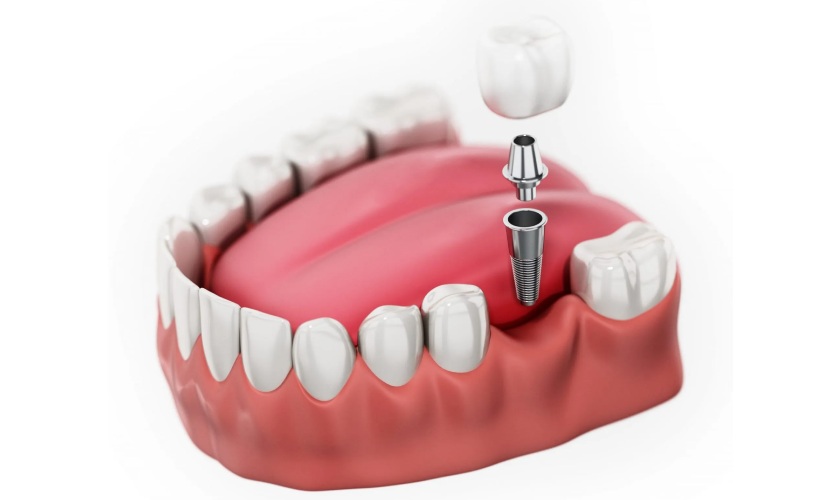Trồng Răng Phục Hình Tháo Lắp: Tổng Quan, Ưu Nhược Điểm Và Chi Phí Dự Kiến 5 top 3 ky thuat trong rang ham implant duoc san don nhat hien nay 0