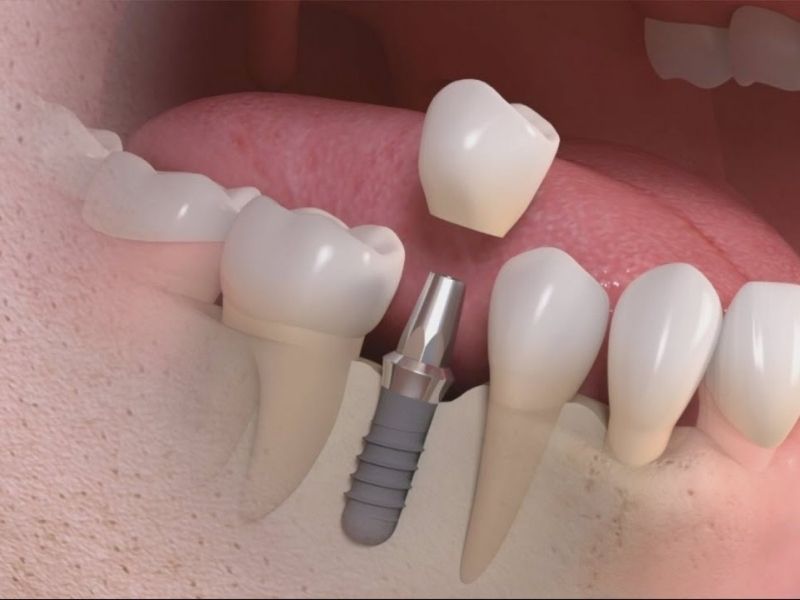 Trồng răng sứ và 3 điều cần biết 8 trong rang co duoc huong bao hiem y te khong hinh anh 1