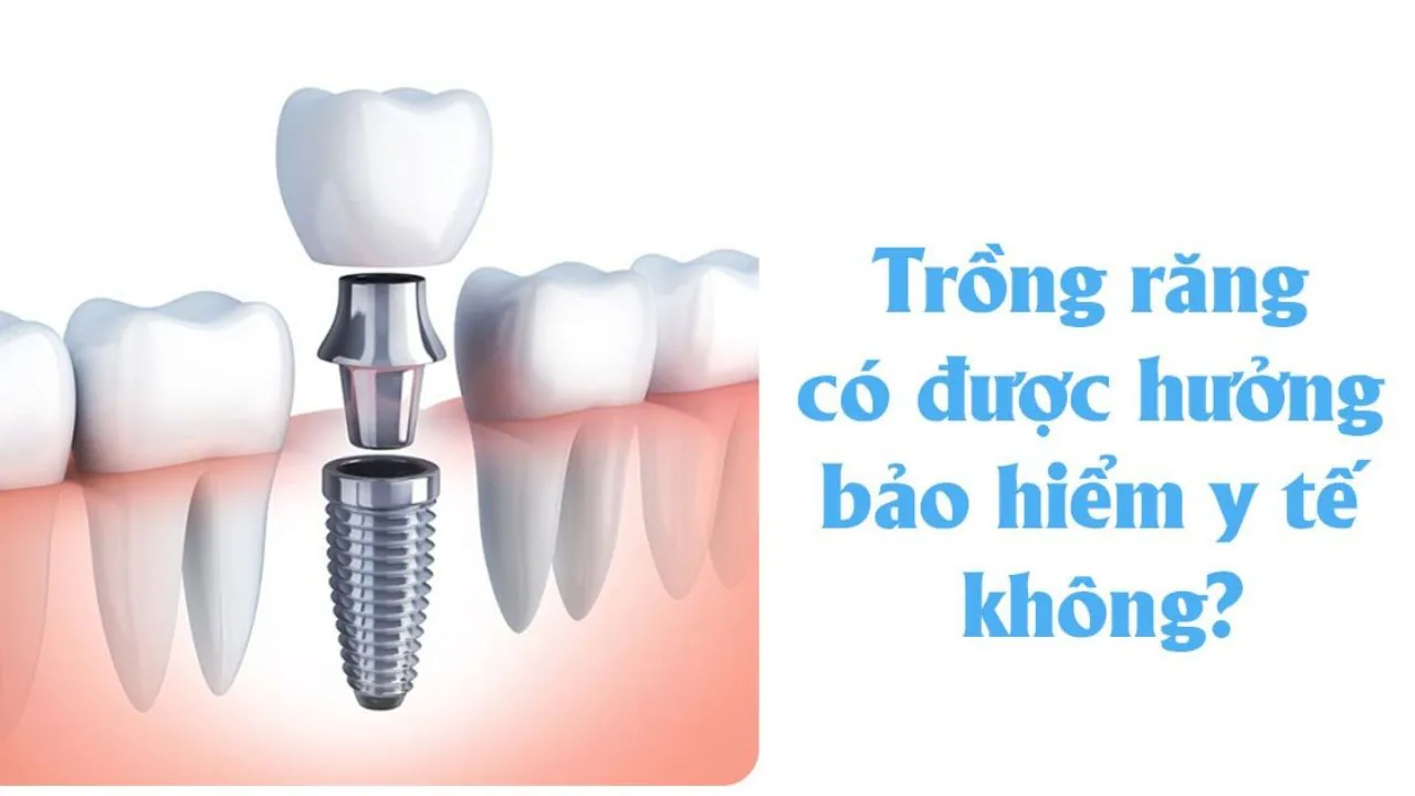 Trồng răng có được hưởng bảo hiểm y tế không?
