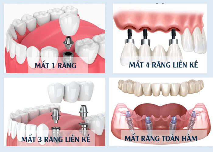 Bọc răng sứ bao nhiêu tiền? Bảng giá mới nhất và 3 điều bạn nên biết 3 Bọc răng sứ bao nhiêu tiền? Bọc răng sứ bao nhiêu tiền? Bọc răng sứ bao nhiêu tiền?