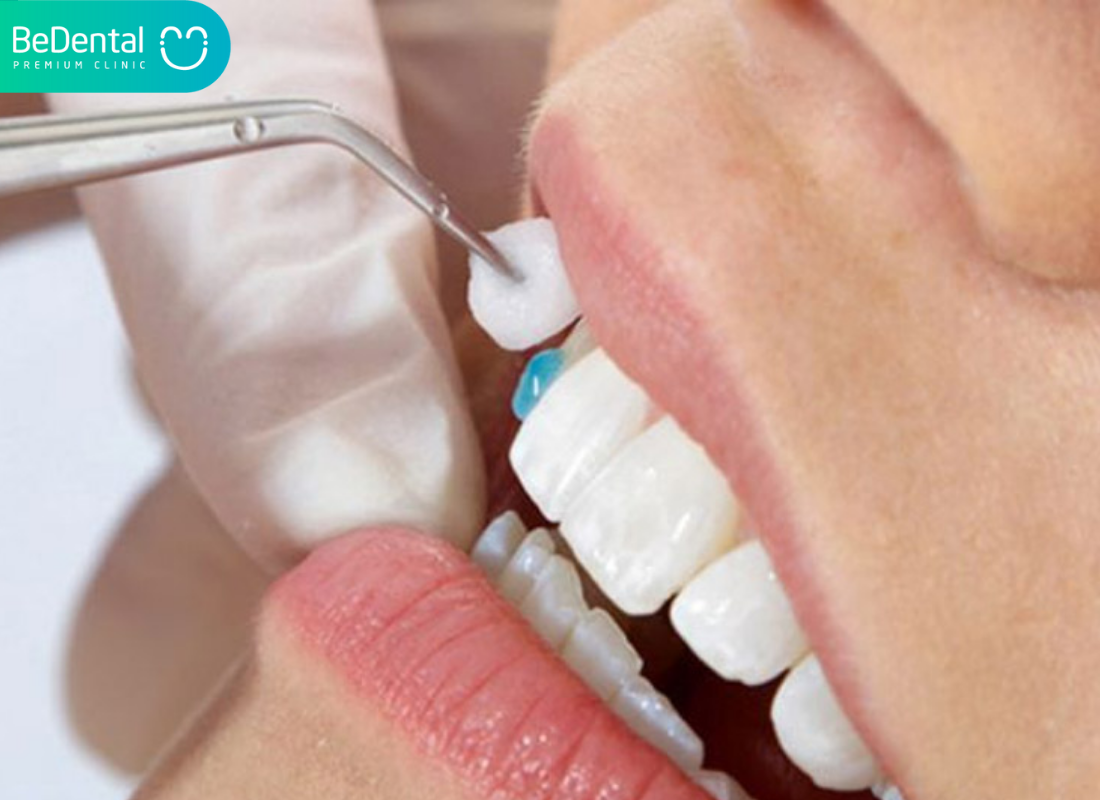 Keo dán răng sứ là gì?