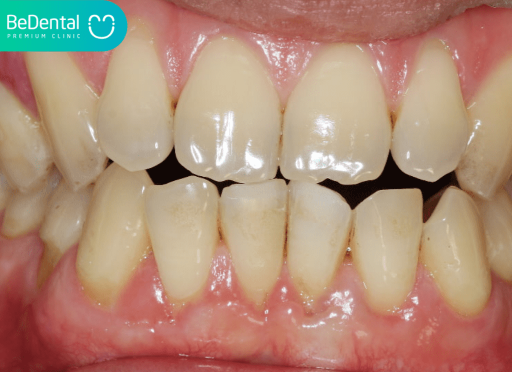 Khớp Cắn Đối Đỉnh