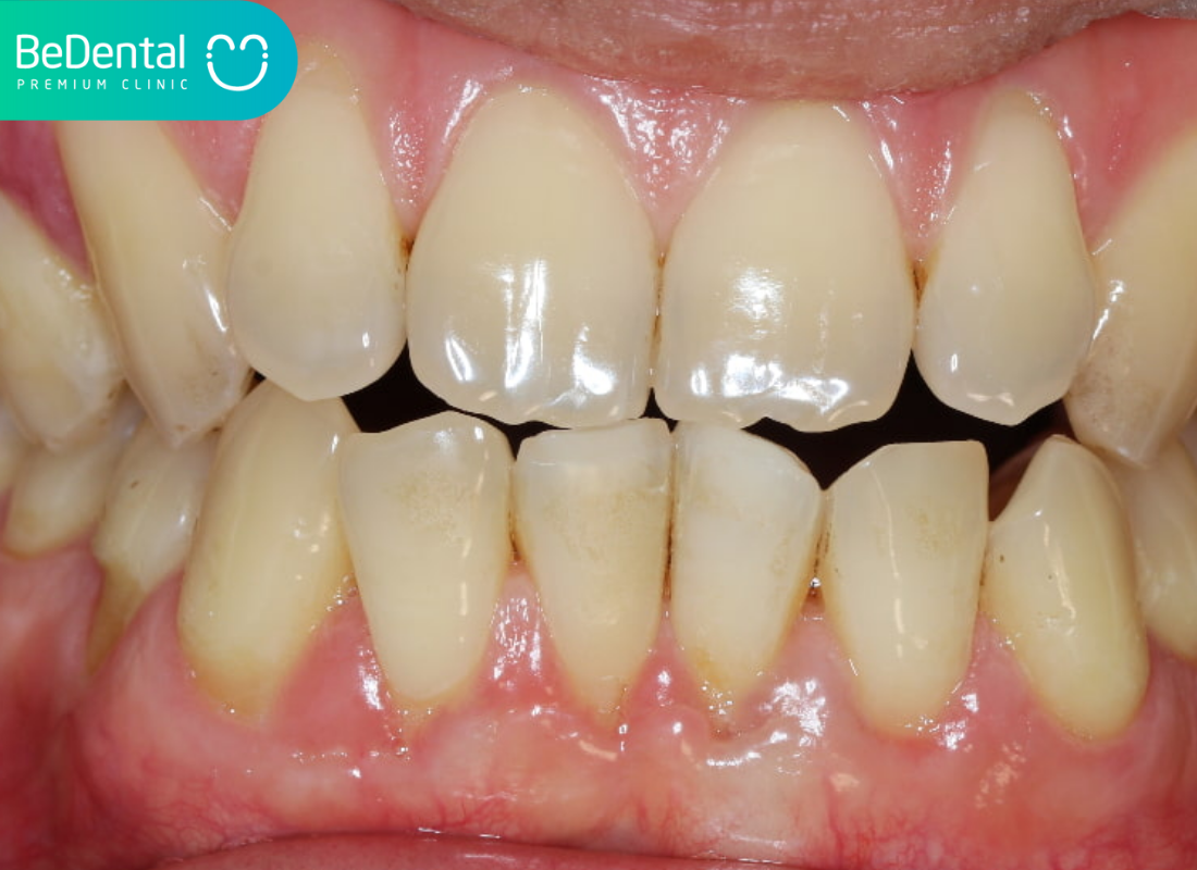 Khớp Cắn Đối Đỉnh