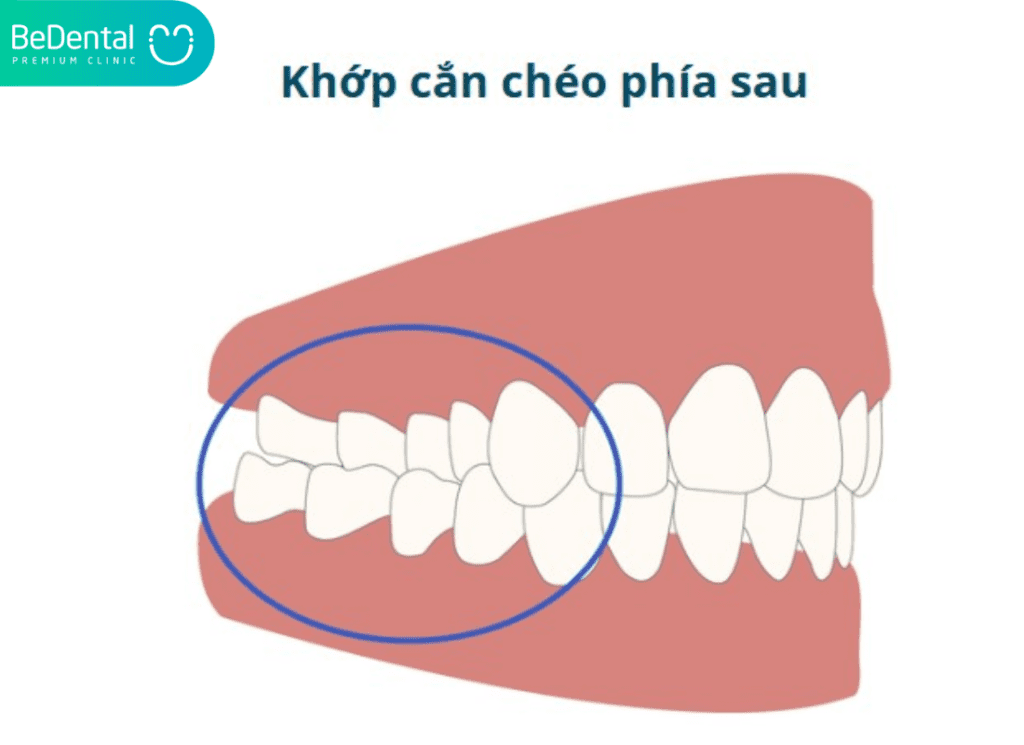 Khop can cheo phia sau
