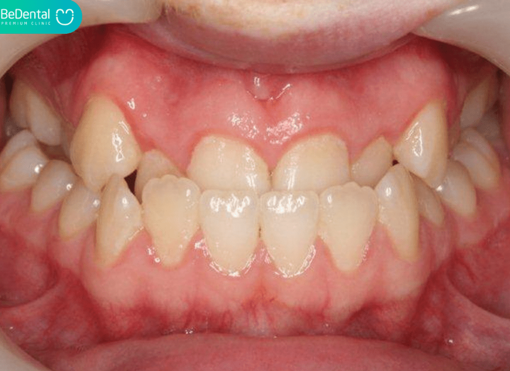 Khớp cắn ngược là gì? Nguyên nhân, biểu hiện và cách điều trị hiệu quả tại Nha khoa Bedental