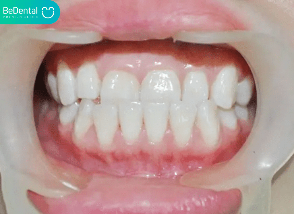 Khớp Cắn Ngược Loại 3: Phân Tích Chuyên Sâu Về Nguyên Nhân, Hậu Quả Và Giải Pháp Điều Trị Tối Ưu 2 Khớp cắn ngược loại 3