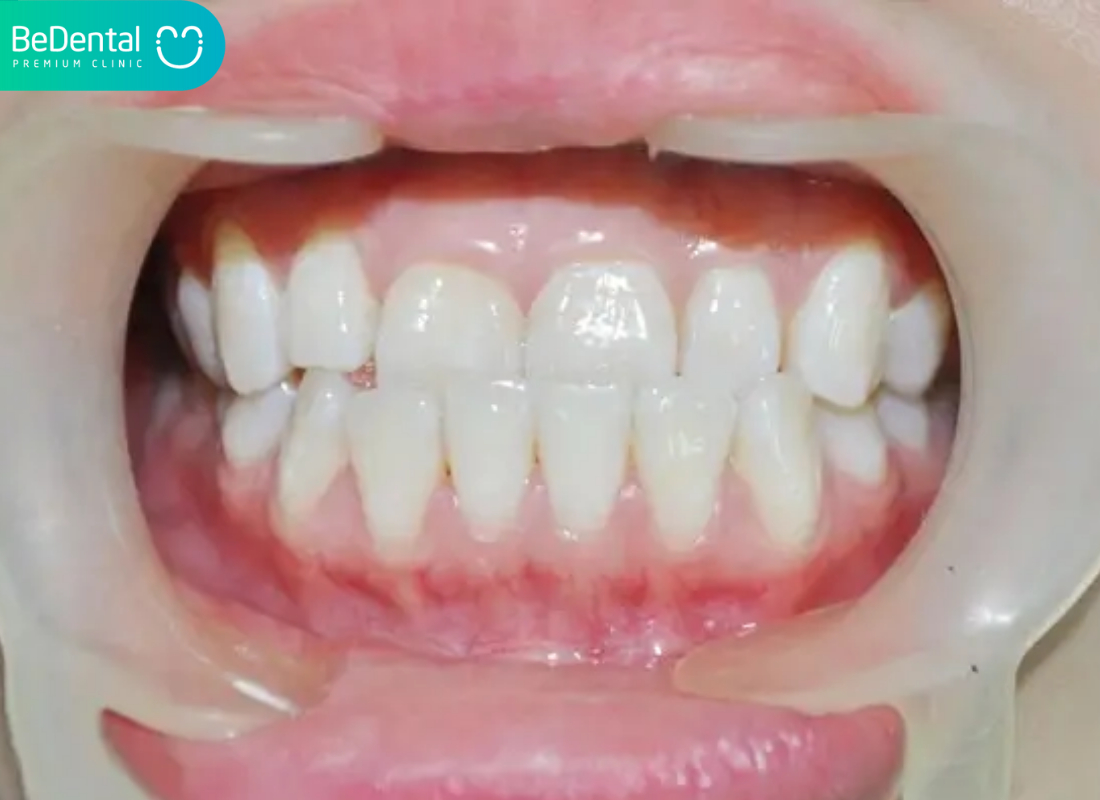 Khớp cắn ngược loại 3