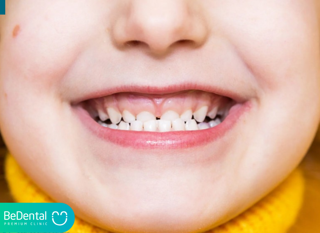 khớp cắn ngược ở trẻ nhỏ