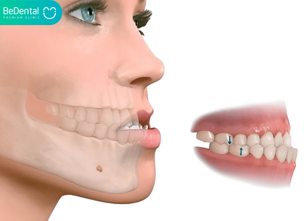 Khớp Cắn Ngược Loại 3: Phân Tích Chuyên Sâu Về Nguyên Nhân, Hậu Quả Và Giải Pháp Điều Trị Tối Ưu 5 Phau thuat mom