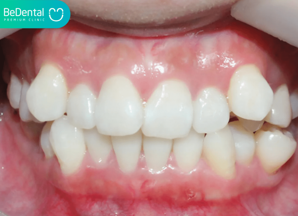 Lệch khớp cắn – Nguyên nhân, dấu hiệu và cách điều trị tối ưu tại Nha khoa Bedental