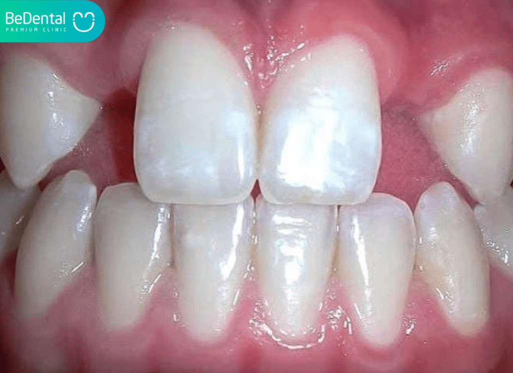 Lệch khớp cắn – Nguyên nhân, dấu hiệu và cách điều trị tối ưu tại Nha khoa Bedental