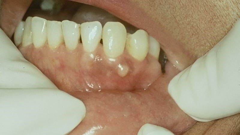 benh u rang5 800x450 1