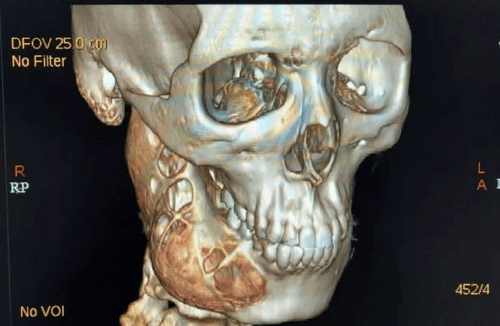 U Men Răng: Nguyên Nhân, Triệu Chứng Và Cách Điều Trị Hiệu Quả 4