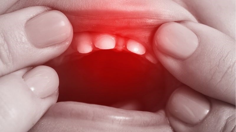 Trẻ sốt mọc răng. Trẻ sốt mọc răng. Trẻ sốt mọc răng. Trẻ sốt mọc răng