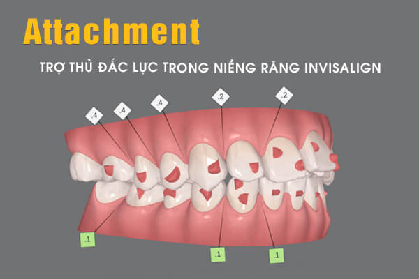 Attachment trong niềng răng Invisalign