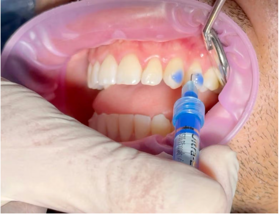 Attachment trong niềng răng Invisalign