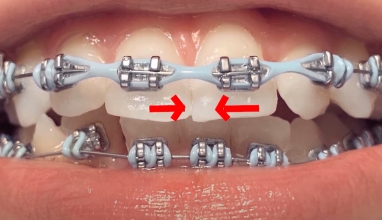 CHUN CHUOI NIENG RANG 3