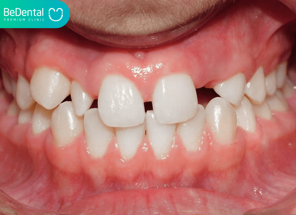 He luy nghiem trong khi thieu mam rang