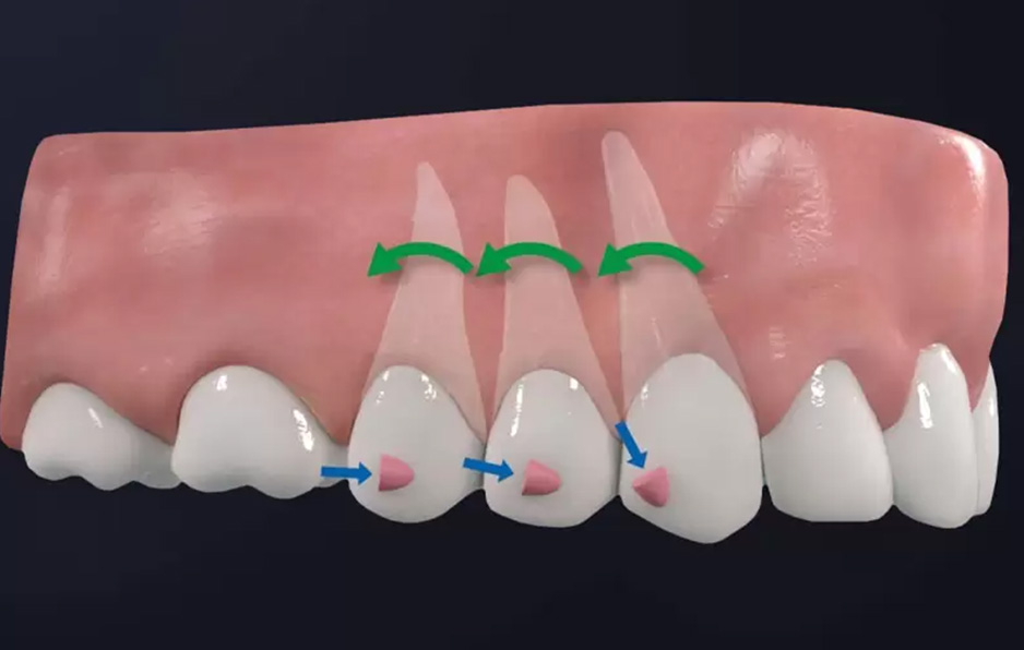 Attachment trong niềng răng Invisalign