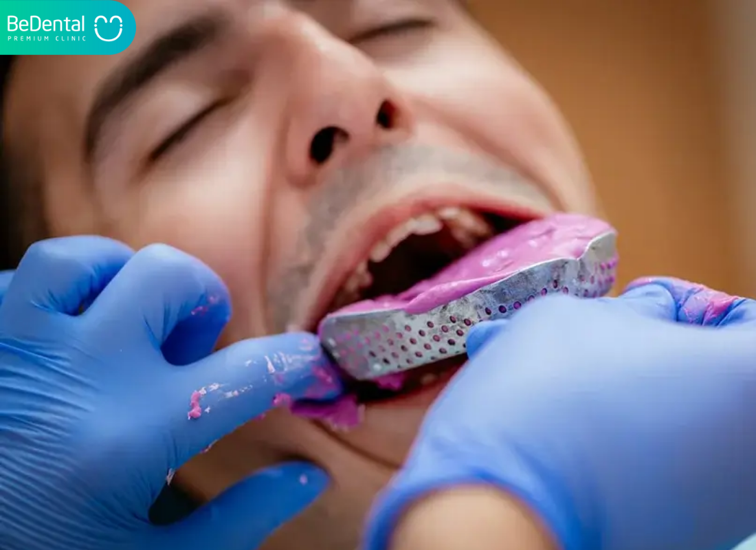 Braces Tightening in Vietnam: How It Compares with International Orthodontic Practices 9 Lay dau rang 01