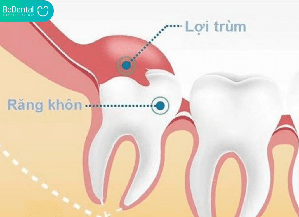Viêm lợi trùm răng khôn khi mang thai