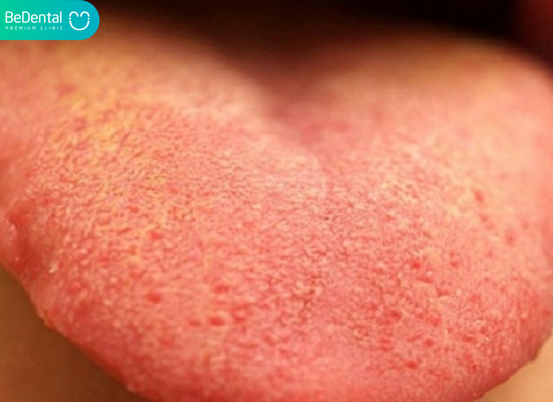 lưỡi nổi hạt đỏ