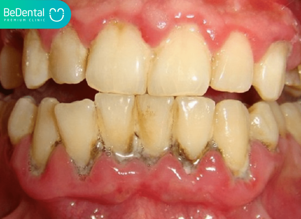 Mảng bám đen trên răng là gì