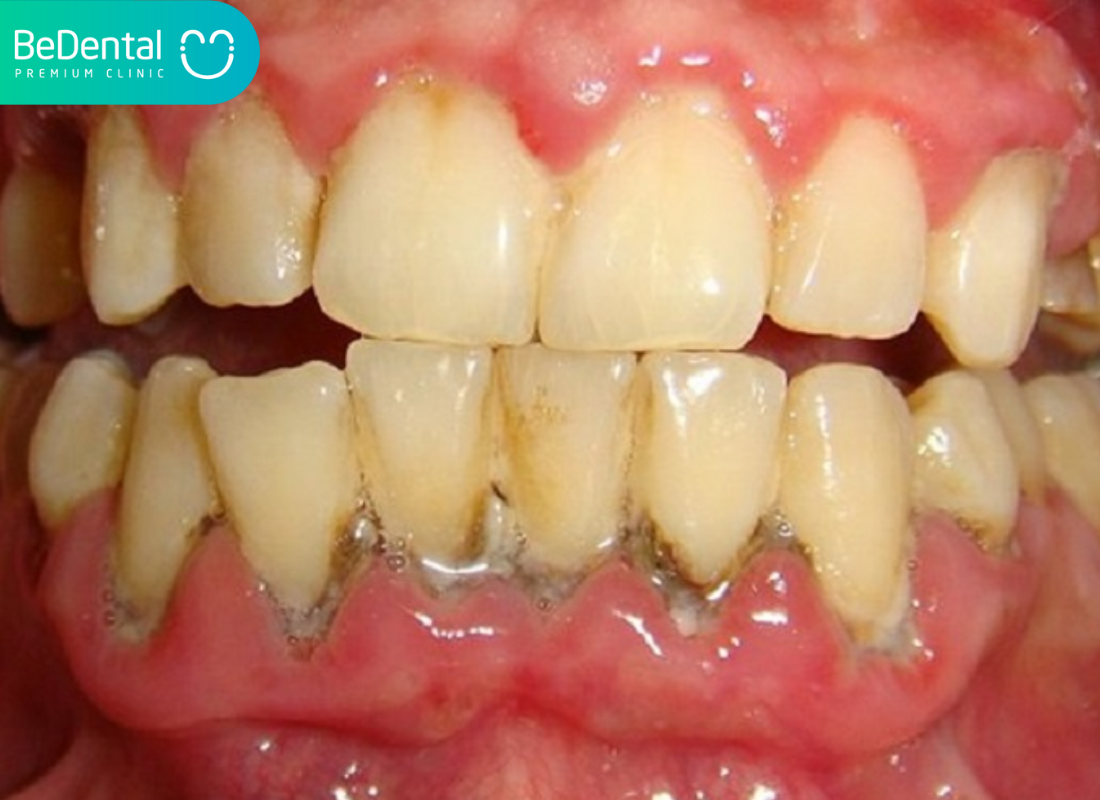 Mảng bám đen trên răng là gì