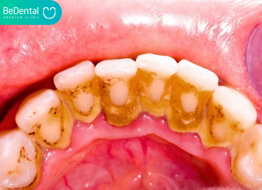 Mảng bám răng là gì