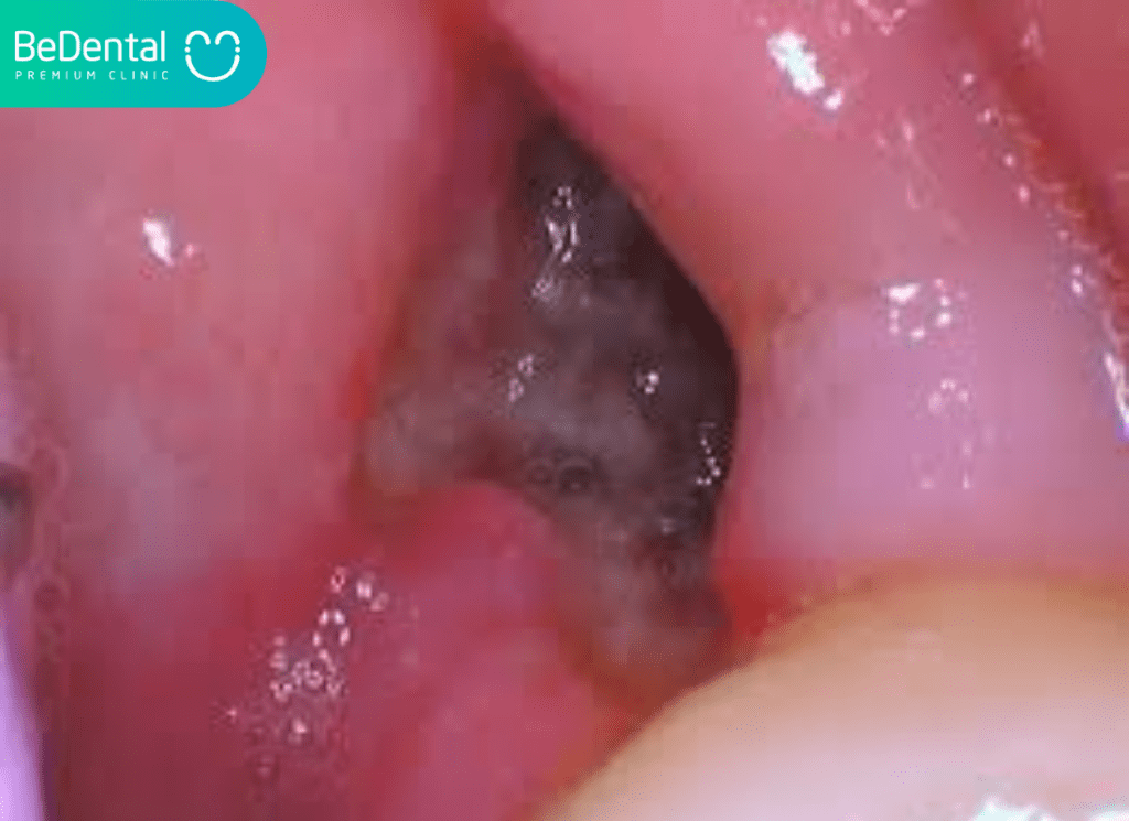 Mang trang sau khi nho rang