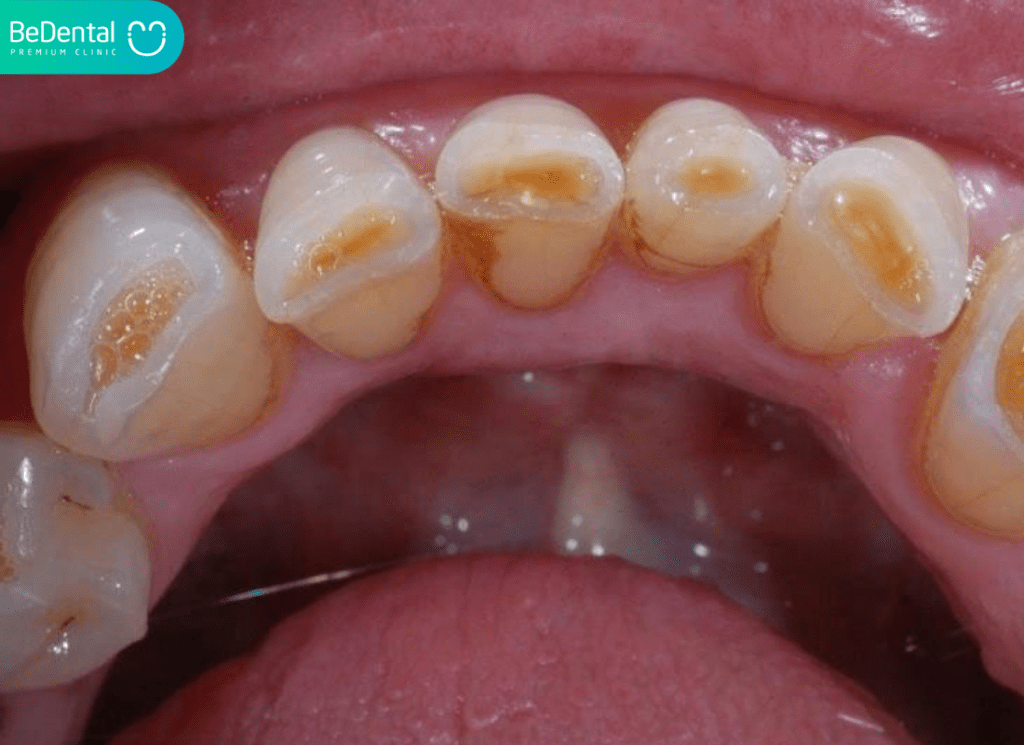 Hướng Dẫn Chi Tiết Cách Tẩy Trắng Răng Bằng Muối Tại Nhà 6 Mon men rang