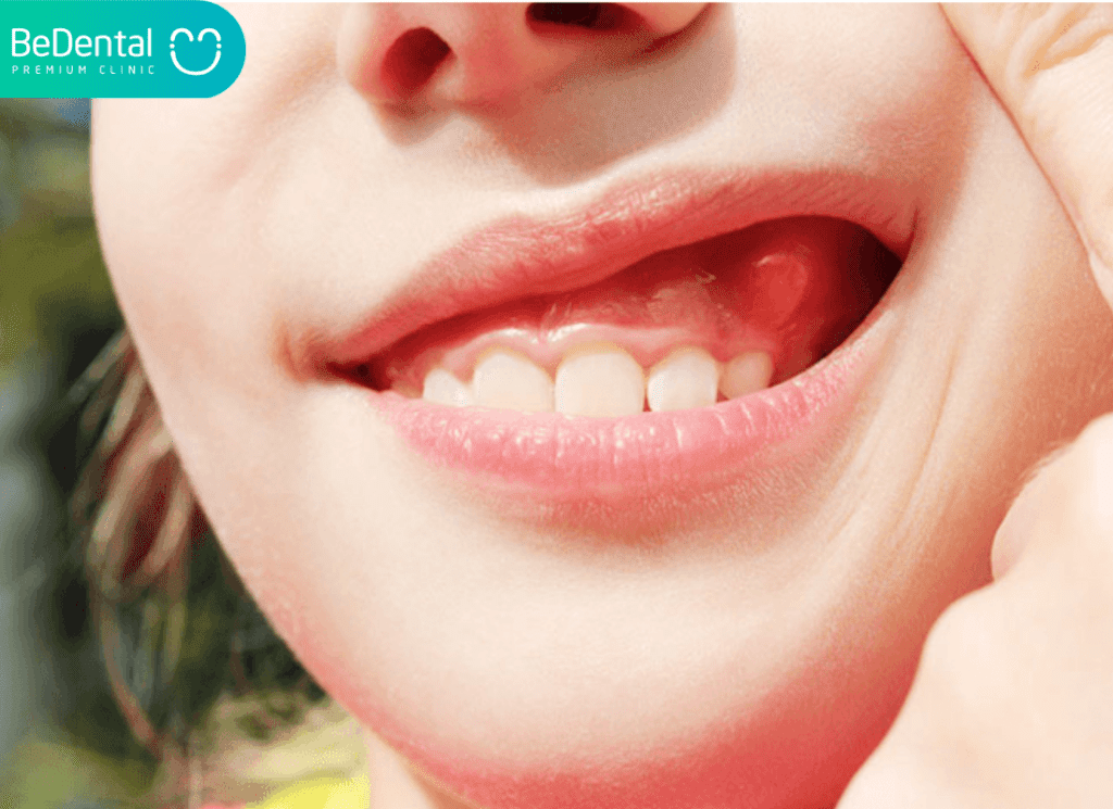 Nang rang co nguy hiem khong